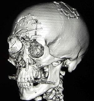skull broken