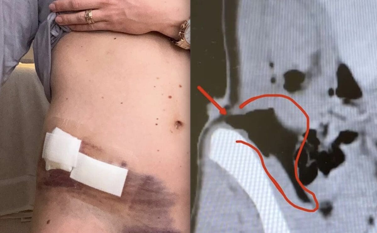 Mikaela Shiffrin injury x-ray