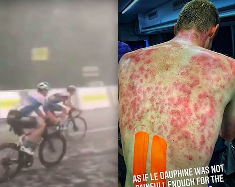 Pro Biker Reveals Nasty Injuries After Racing Through Hail Storm