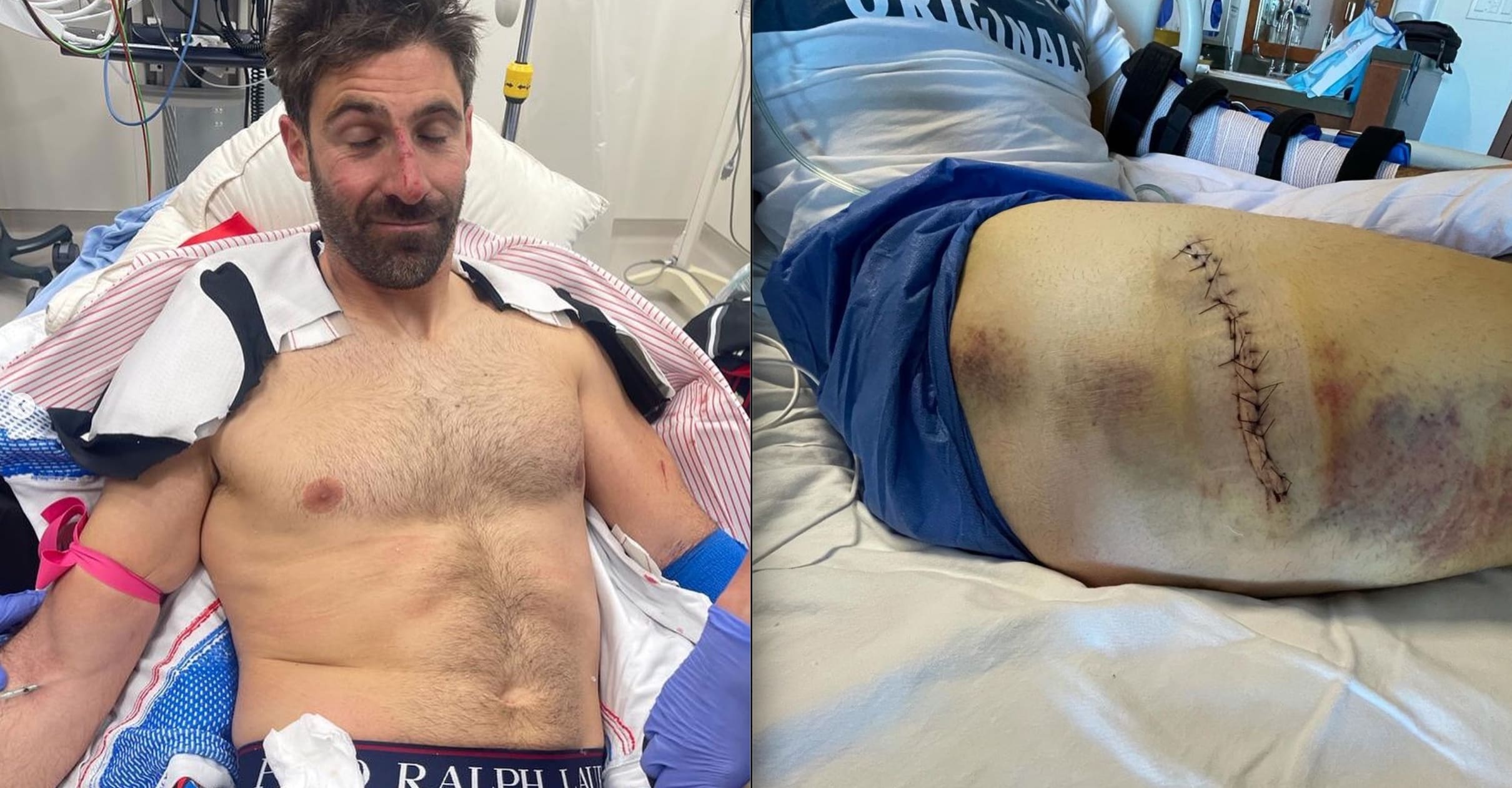 French Ski Racer Recovering After Getting Gouged By Tree Branch During Training